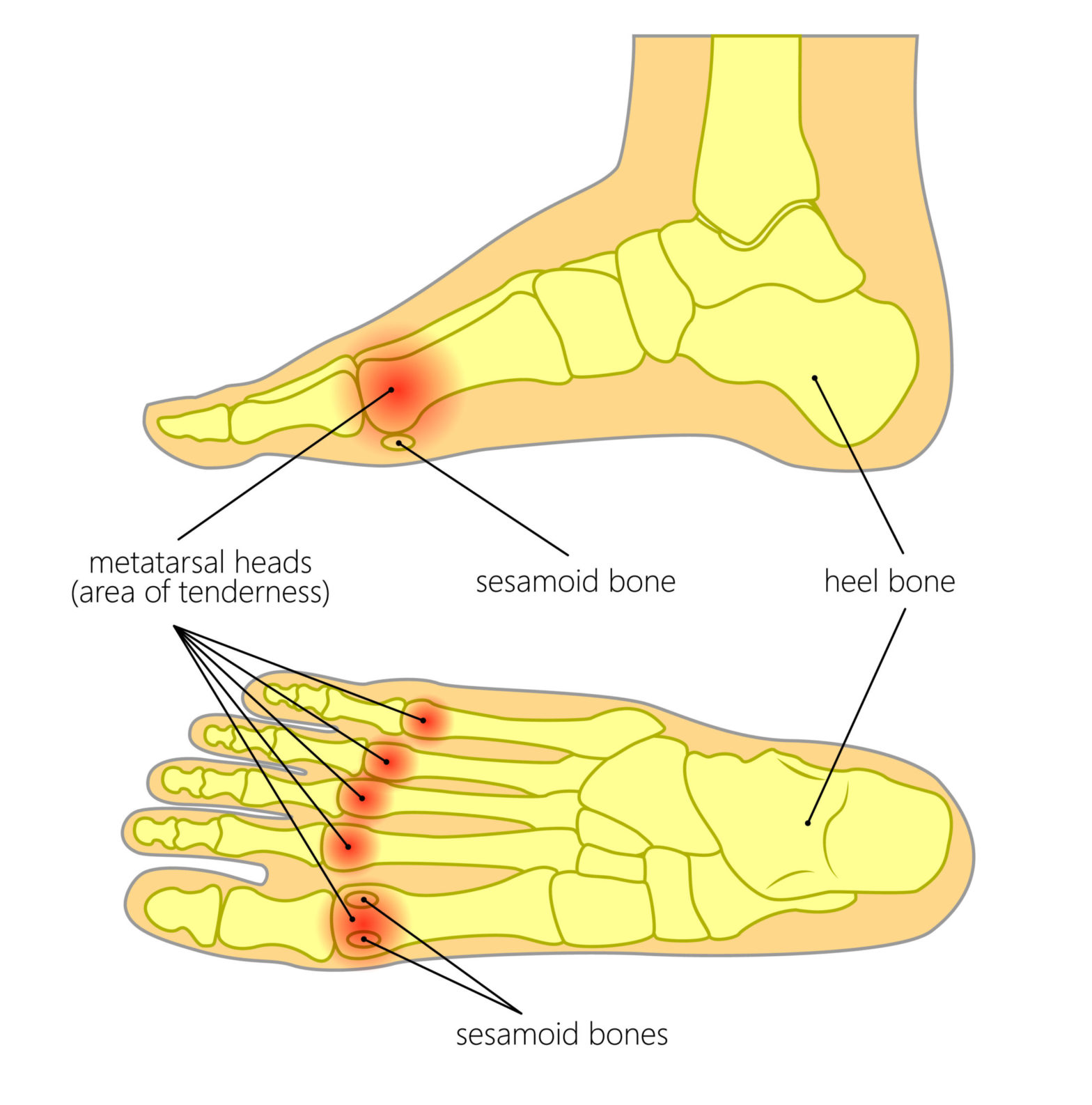 right first metatarsal pain icd 10