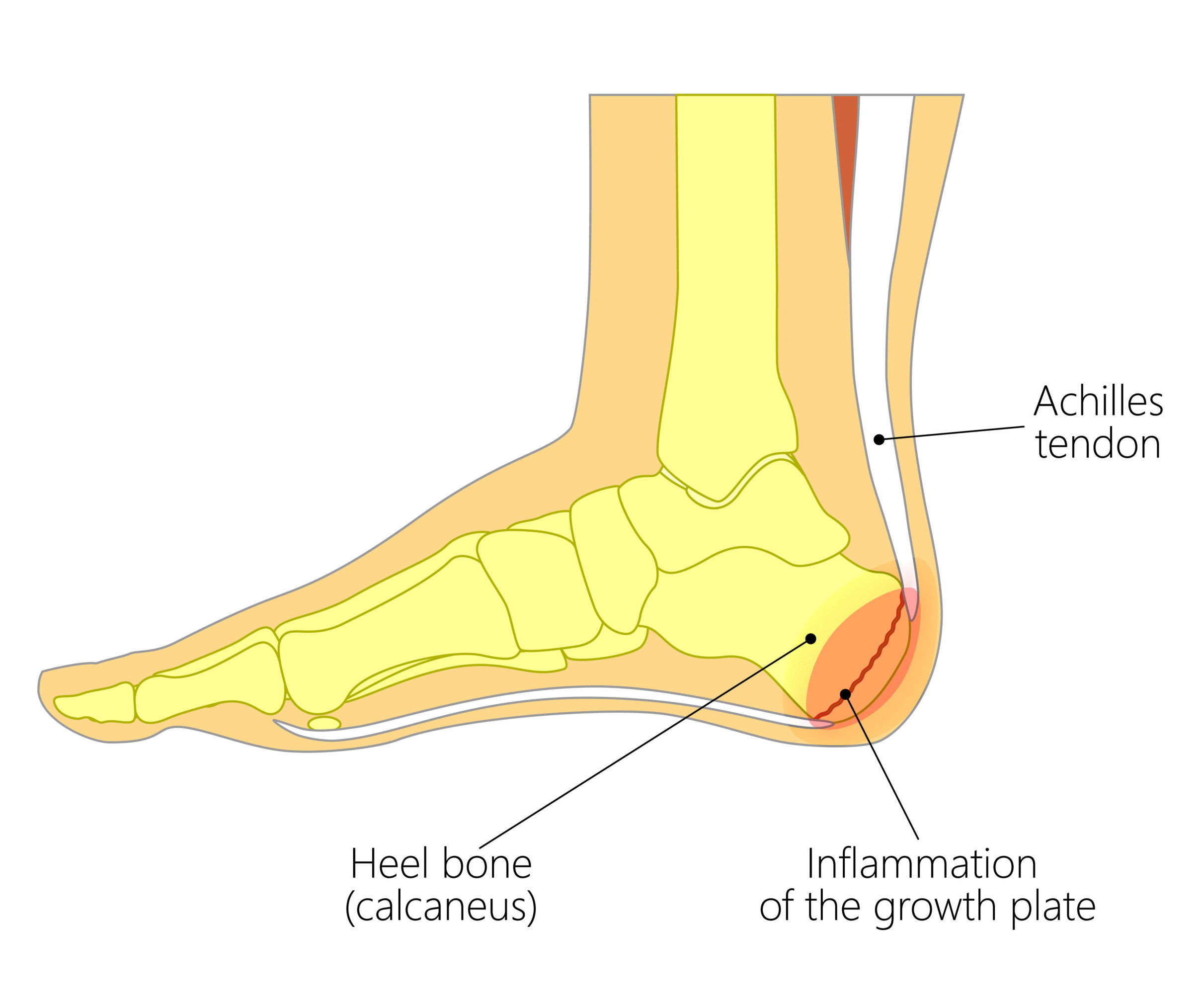 Sever s Disease Marie Whitfield Podiatry